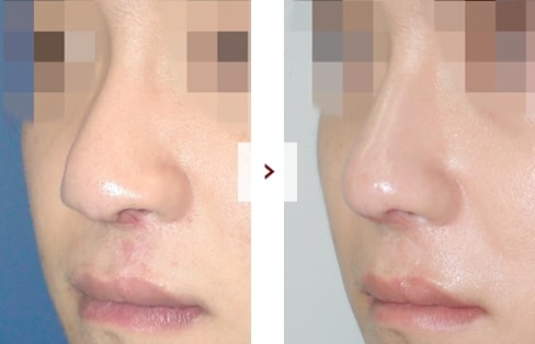 Cleft Lip Rhinoplasty Surgery Before and After