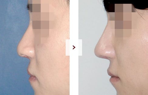 Cleft Lip Rhinoplasty Surgery Before and After