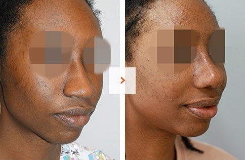 Ethnic Rhinoplasty Before and After