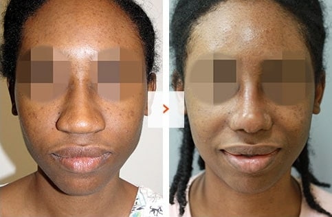 Ethnic Rhinoplasty Before and After