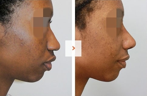 Ethnic Rhinoplasty Before and After