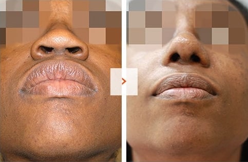 Ethnic Rhinoplasty Before and After