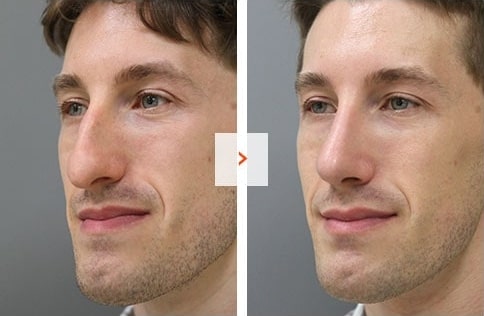 Ethnic Rhinoplasty Before and After