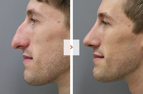 Ethnic Rhinoplasty Before and After