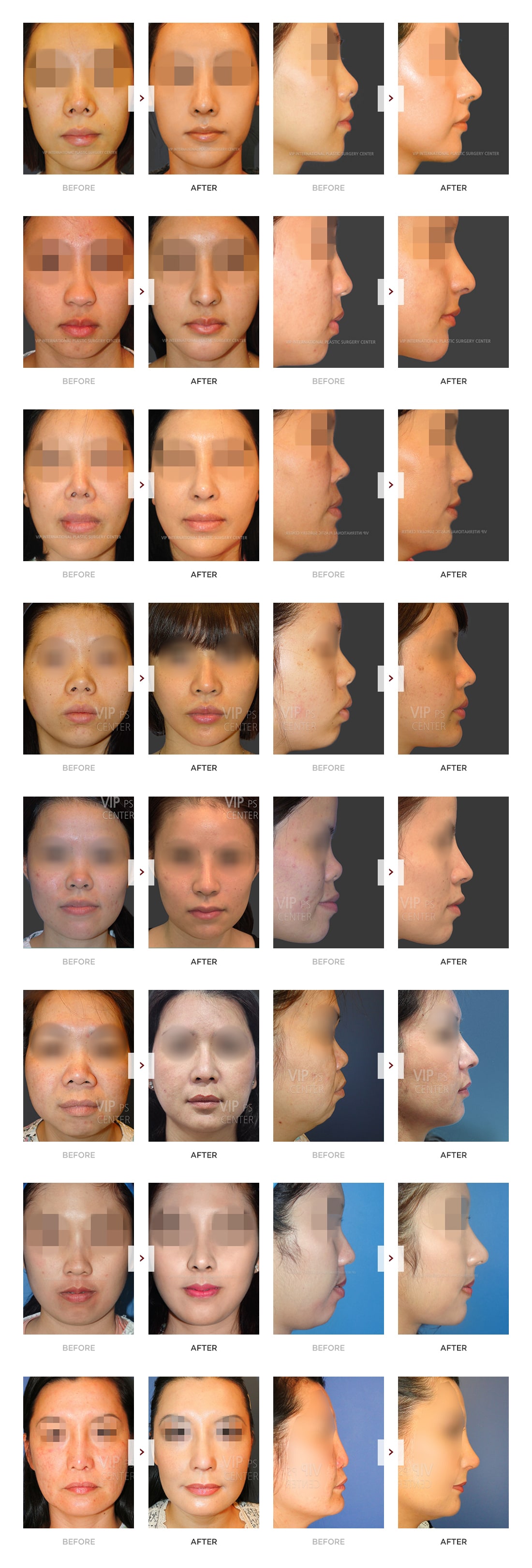 Harmony Rhinoplasty Before and After