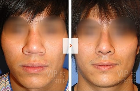 Male Rhinoplasty Before and After