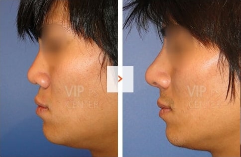 Male Rhinoplasty Before and After