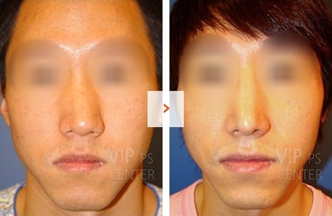 Male Rhinoplasty Before and After