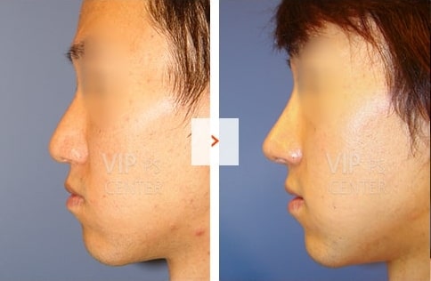 Male Rhinoplasty Before and After