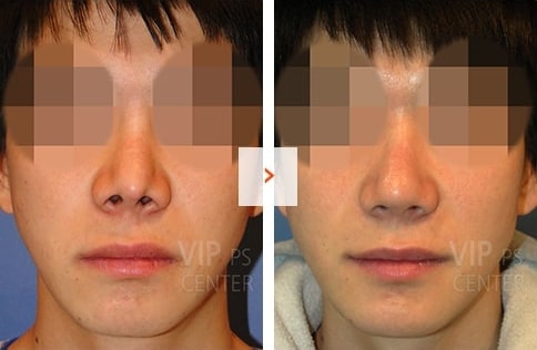 Male Rhinoplasty Before and After