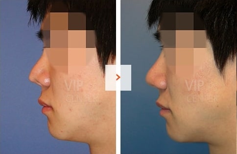 Male Rhinoplasty Before and After