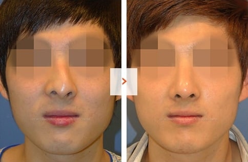 Male Rhinoplasty Before and After