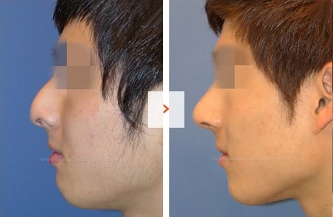 Male Rhinoplasty Before and After