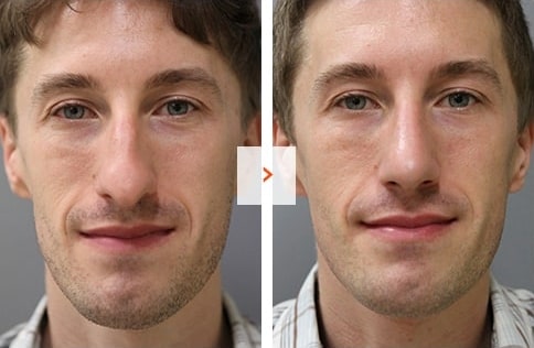 Male Rhinoplasty Before and After