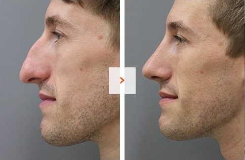 Male Rhinoplasty Before and After