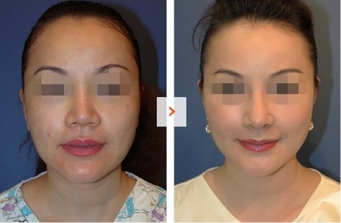 Mid-face augmentation and Rhinoplasty Before and After