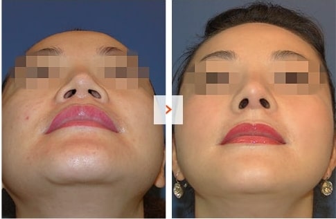 Mid-face augmentation and Rhinoplasty Before and After