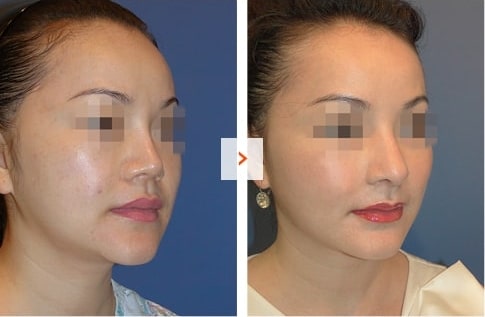 Mid-face augmentation and Rhinoplasty Before and After