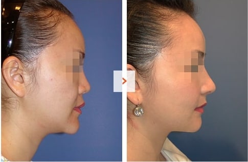 Mid-face augmentation and Rhinoplasty Before and After