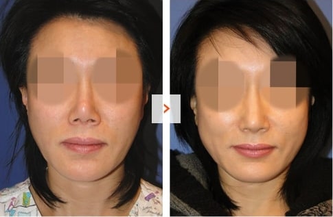 Mid-face augmentation and Rhinoplasty Before and After