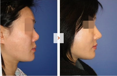 Mid-face augmentation and Rhinoplasty Before and After