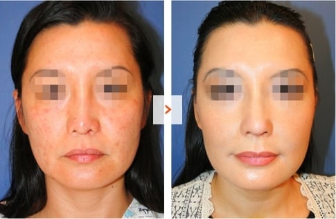 Mid-face augmentation and Rhinoplasty Before and After