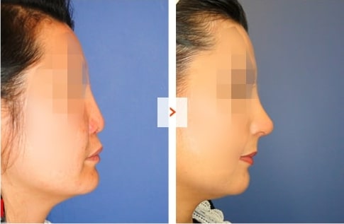 Mid-face augmentation and Rhinoplasty Before and After