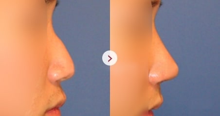 Hump Nose before and after