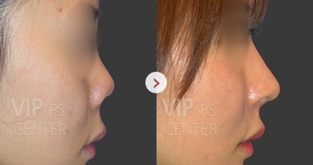 Contracted/Upturned Nose before and after