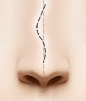 Deviation after Rhinoplasty