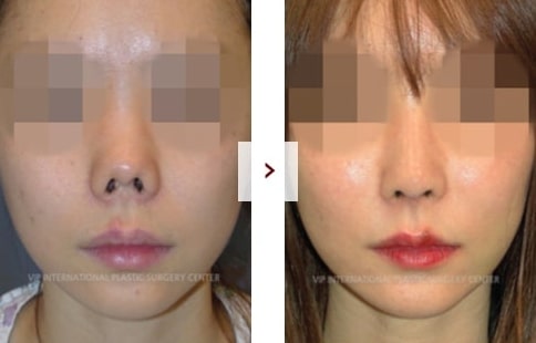 Perbaikan Rhinoplasty Sebelum & Sesudah