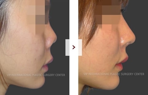 Perbaikan Rhinoplasty Sebelum & Sesudah