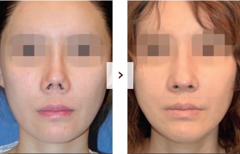 Perbaikan Rhinoplasty Sebelum & Sesudah