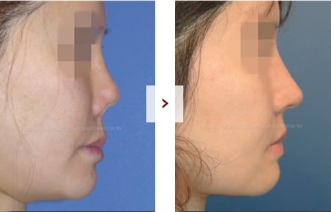 Perbaikan Rhinoplasty Sebelum & Sesudah