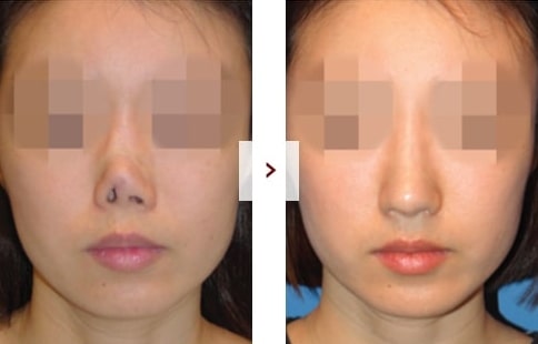 Perbaikan Rhinoplasty Sebelum & Sesudah