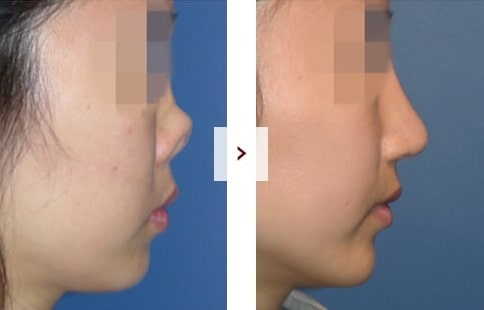 Perbaikan Rhinoplasty Sebelum & Sesudah