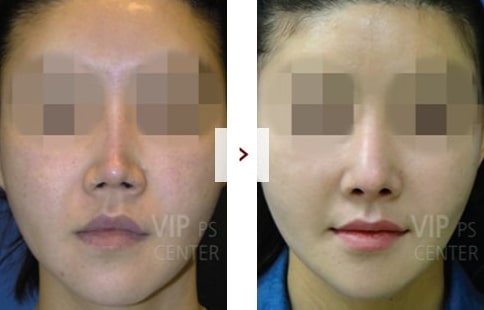 Perbaikan Rhinoplasty Sebelum & Sesudah