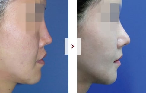 Perbaikan Rhinoplasty Sebelum & Sesudah