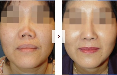 Perbaikan Rhinoplasty Sebelum & Sesudah