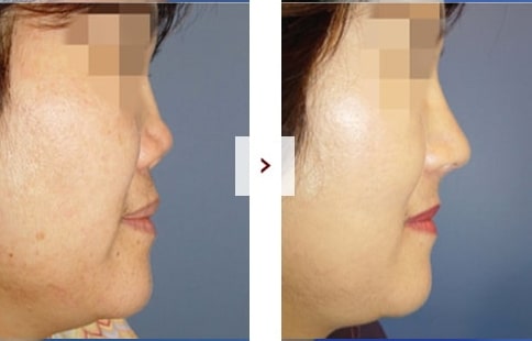 Perbaikan Rhinoplasty Sebelum & Sesudah