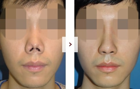 Perbaikan Rhinoplasty Sebelum & Sesudah