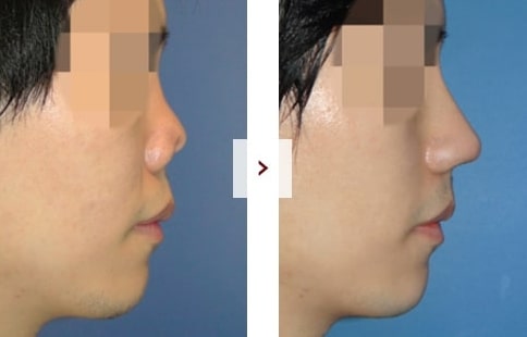 Perbaikan Rhinoplasty Sebelum & Sesudah