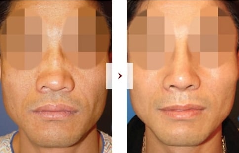 Perbaikan Rhinoplasty Sebelum & Sesudah