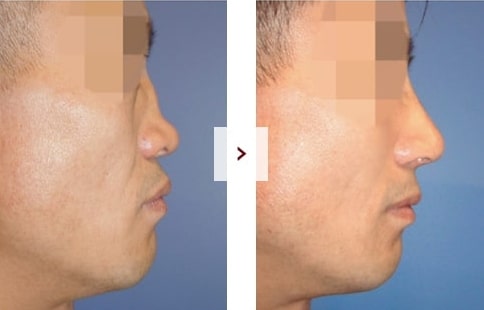 Perbaikan Rhinoplasty Sebelum & Sesudah