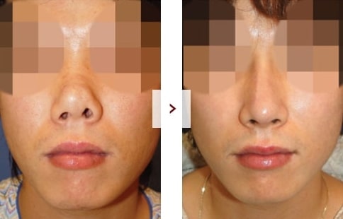 Perbaikan Rhinoplasty Sebelum & Sesudah