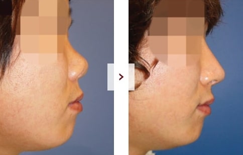 Perbaikan Rhinoplasty Sebelum & Sesudah