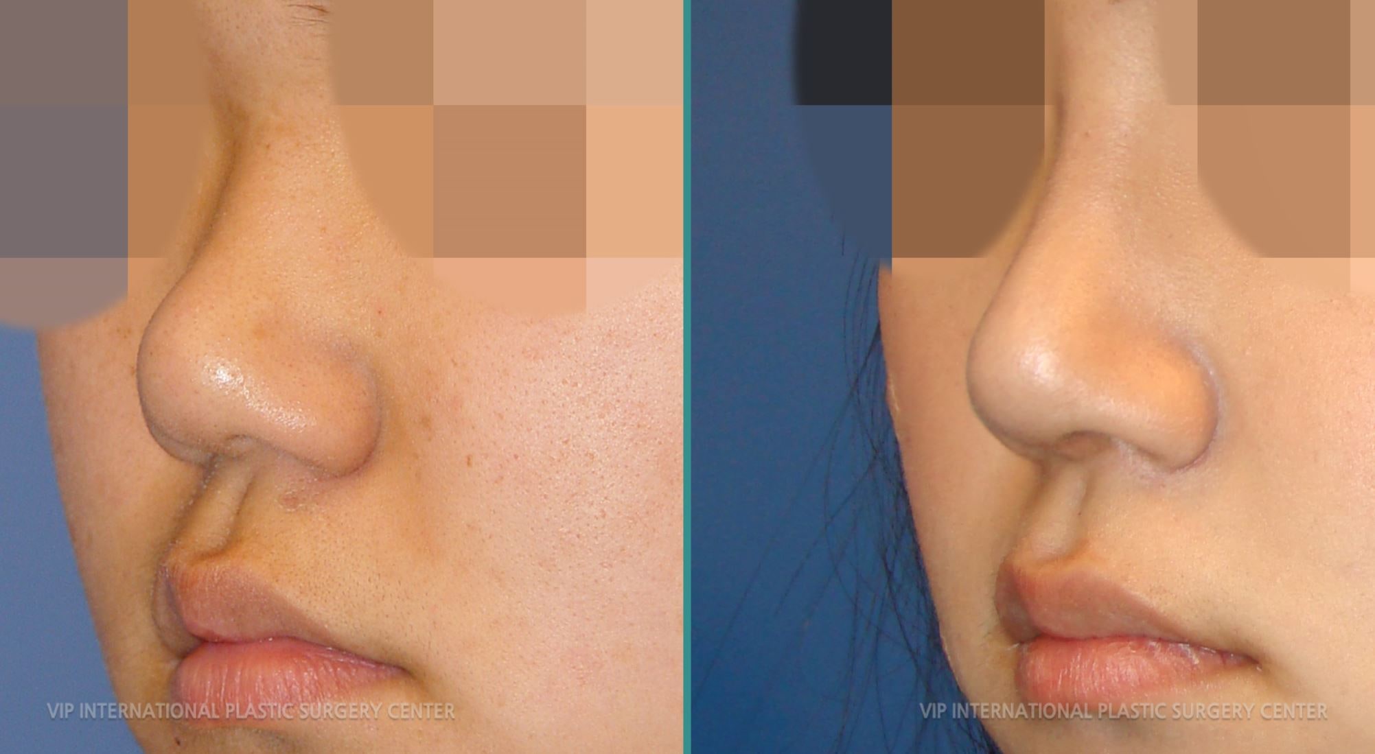 Revision Rhinoplasty Before and After(Stubby Nose)
