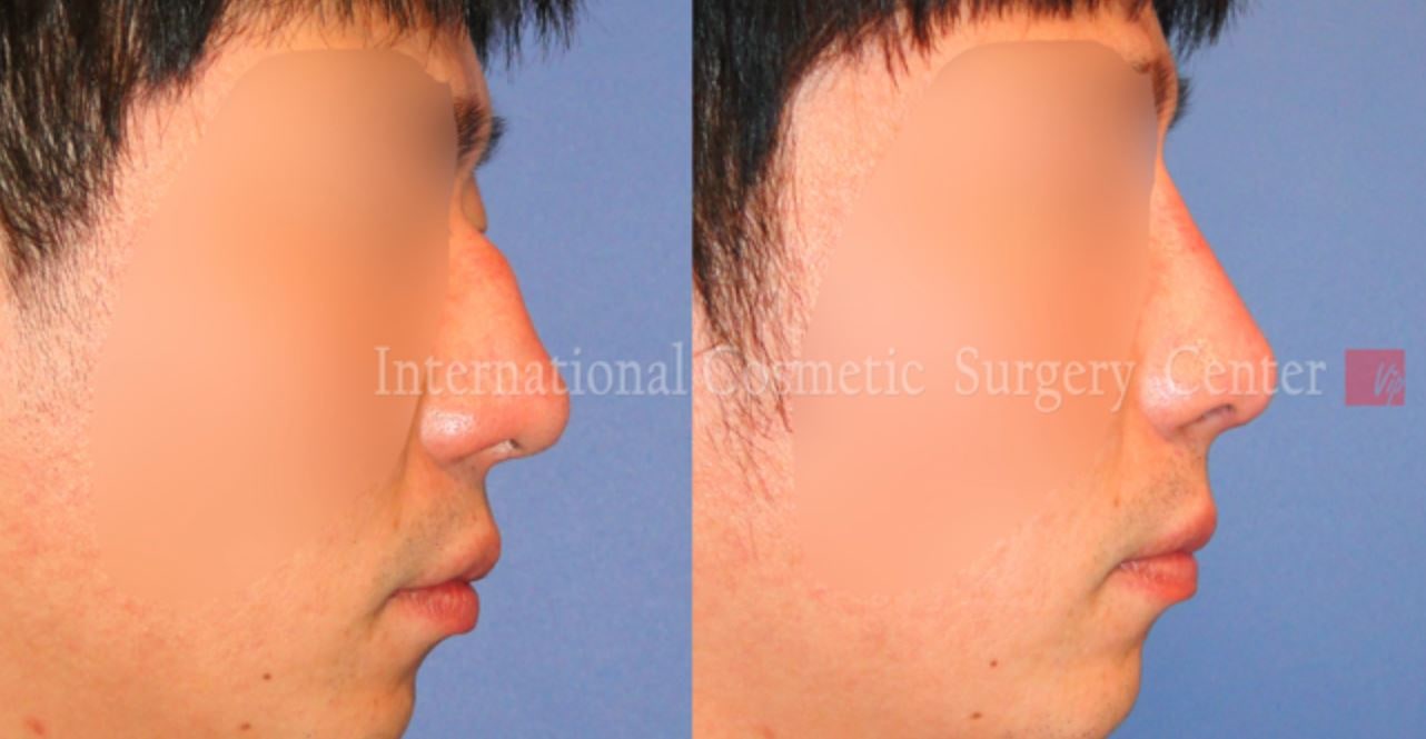 Revision Rhinoplasty Before and After(Droopy Nose)