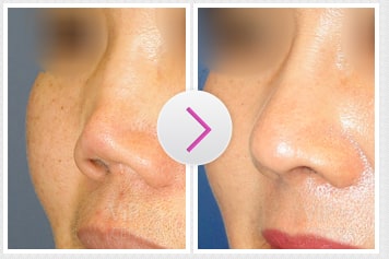 Columella Retruded Nose Before and After