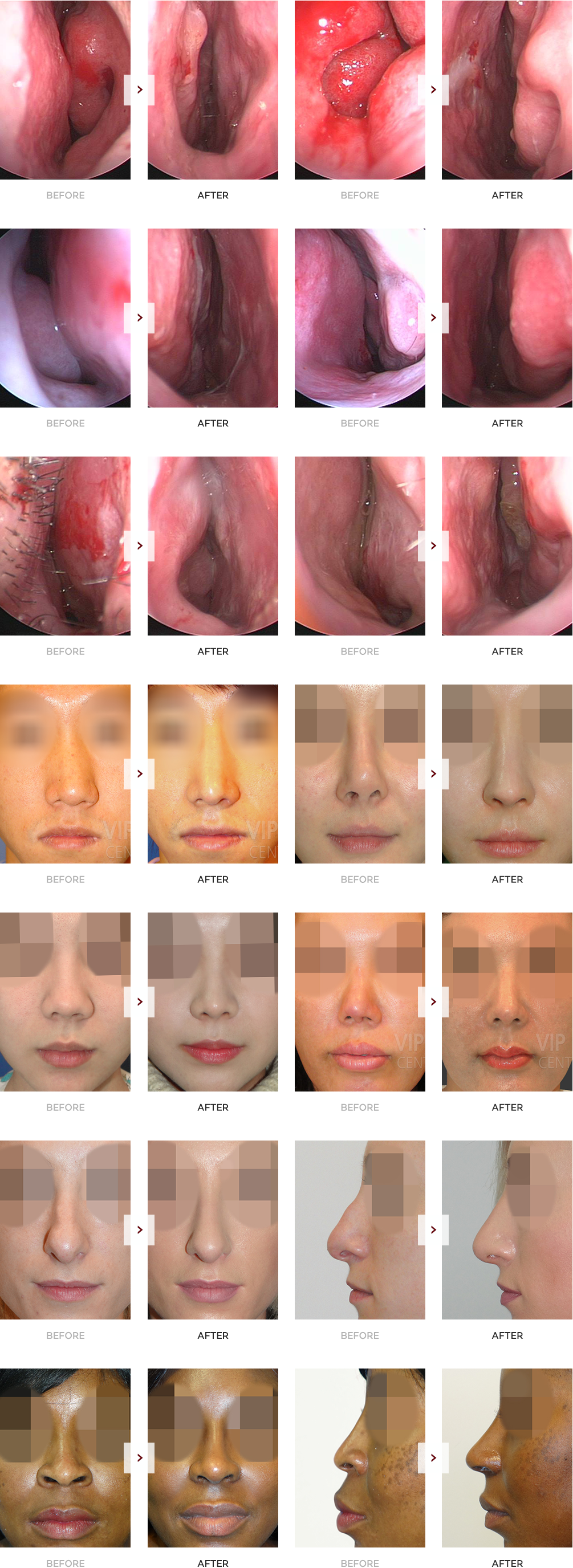 Revision Septal Deviation case Before and After